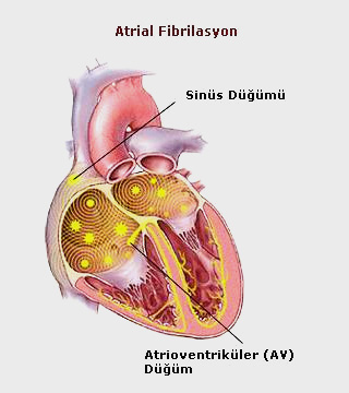 atrial-fibrilasyon01